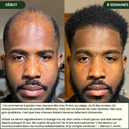 Système Capillaire Micro-infusion renaitlab® Homme