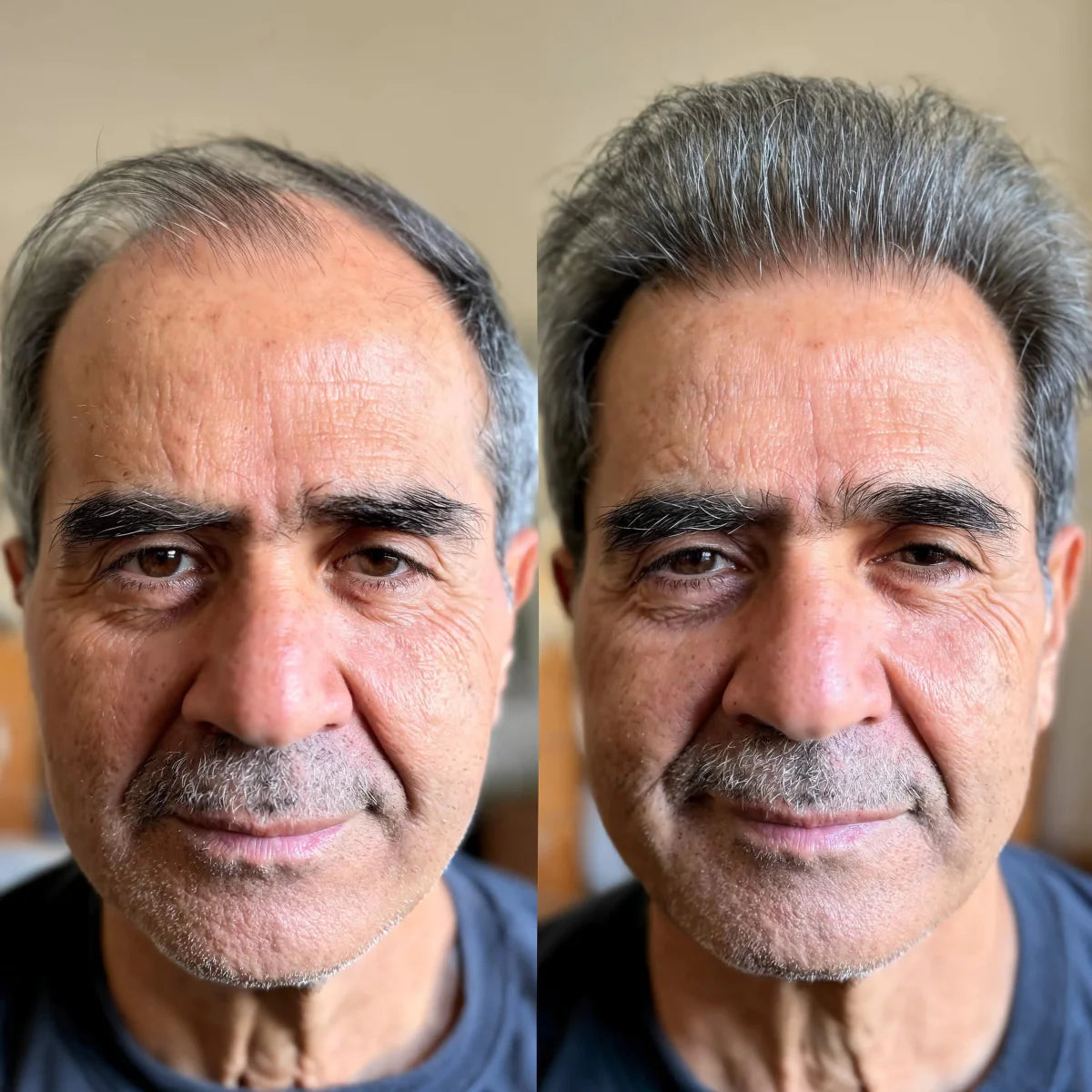 Système Capillaire Micro-infusion renaitlab® Homme